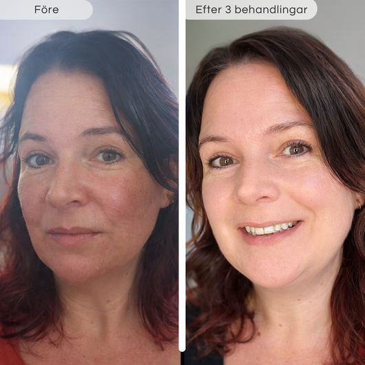 Microinfusionkit – Förnyar huden på djupet