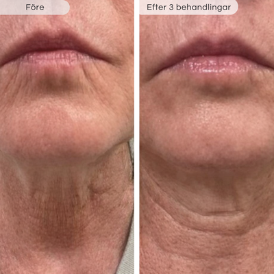 Microinfusionkit – Förnyar huden på djupet