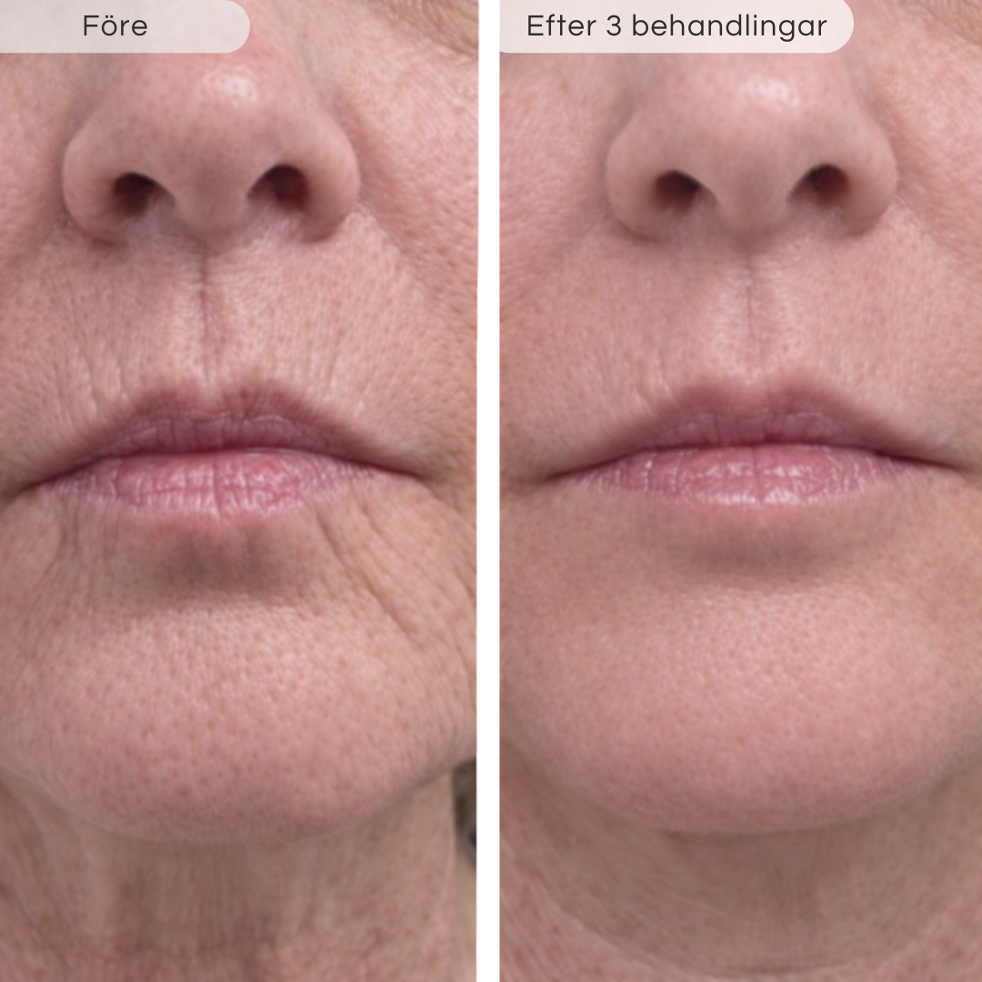 Microinfusionkit Peptides fokuserad