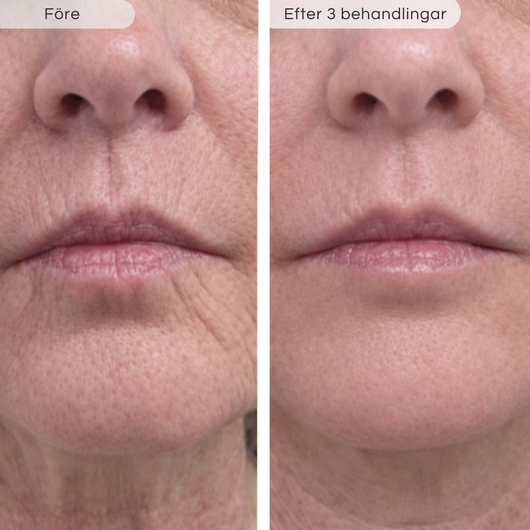 Microinfusionkit – Förnyar huden på djupet